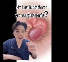 ริดสีดวงรูปจริง